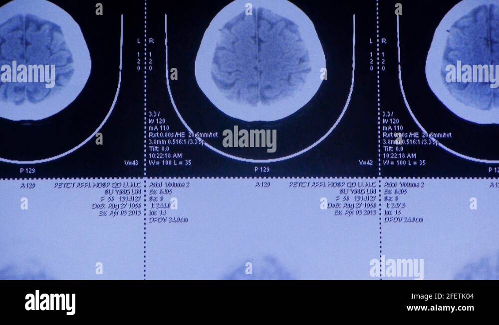 moving head pet cT scan,skull brain X-ray Stock Video Footage - Alamy