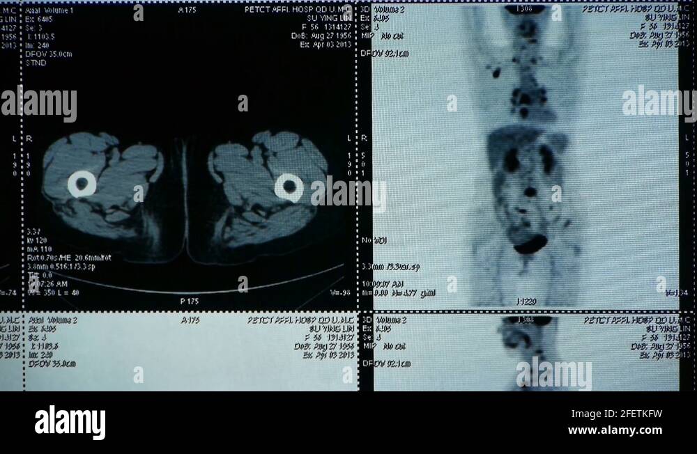 doctor study human orage & bone pet-ct scan,X-ray,Cancer metastasis ...