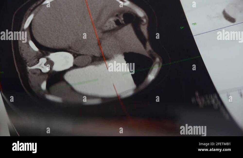 doctor study color head & vertebral pet-ct,skull brain X-ray Stock ...
