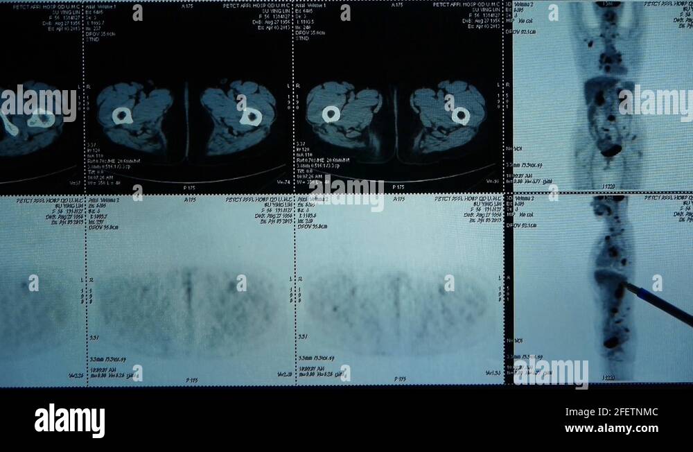 doctor study human orage & bone pet-ct scan,X-ray,Cancer metastasis ...