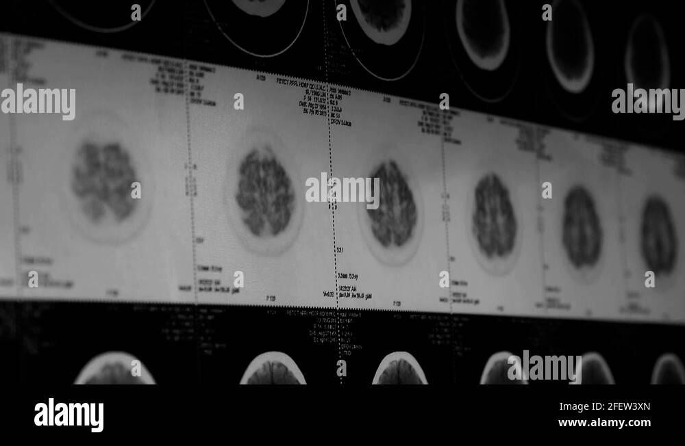 moving head pet cT scan,skull brain X-ray Stock Video Footage - Alamy