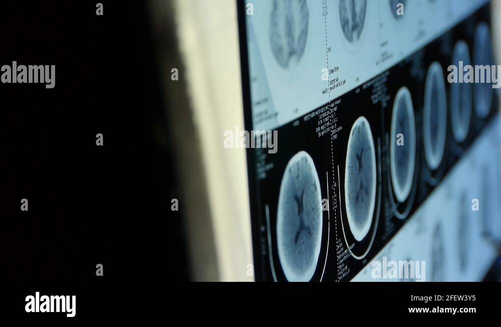 doctor study head pet/ct scan for analysis the disease,skull brain X ...