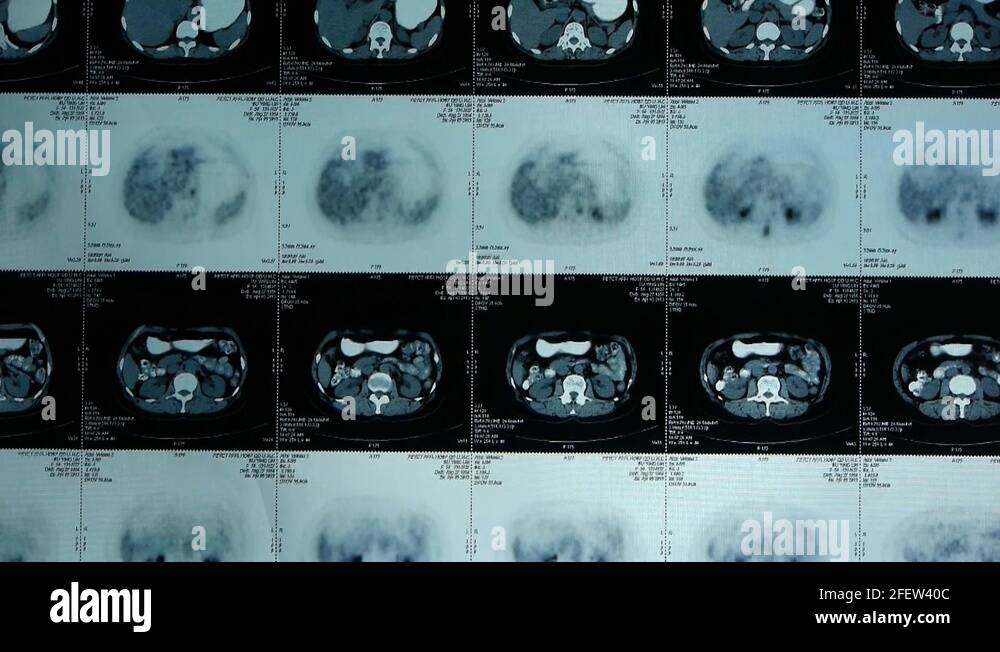 moving human organ pet-ct scan,lymph nodes X-ray,Cancer metastasis ...