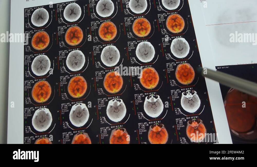 doctor study color head pet-ct,skull brain X-ray Stock Video Footage ...