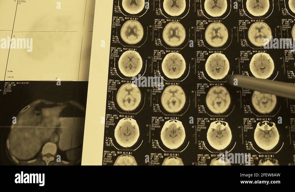doctor study color head & vertebral pet-ct,skull brain X-ray Stock ...