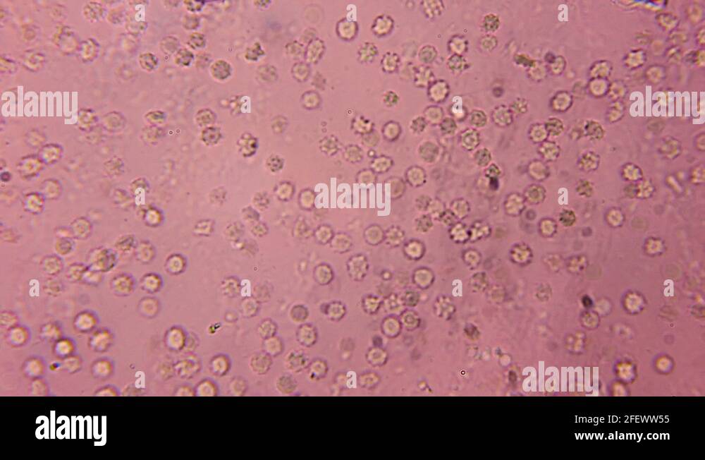 Damaged red blood cells Stock Videos & Footage - HD and 4K Video Clips ...