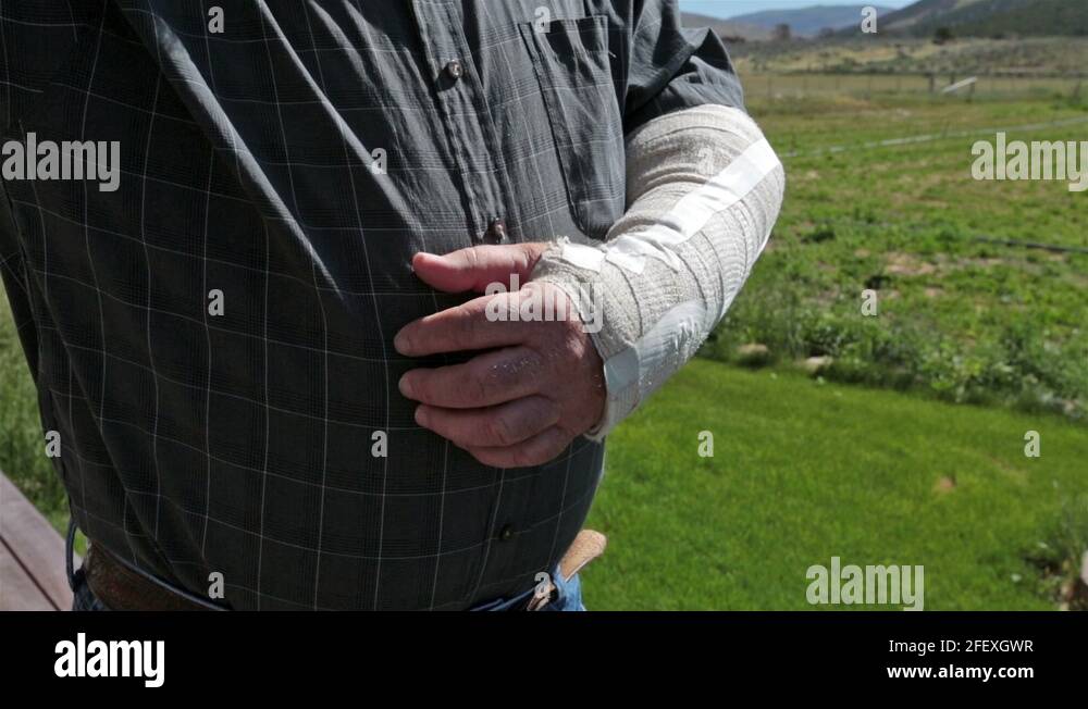 Fractured arm cast Stock Videos & Footage HD and 4K Video Clips Alamy