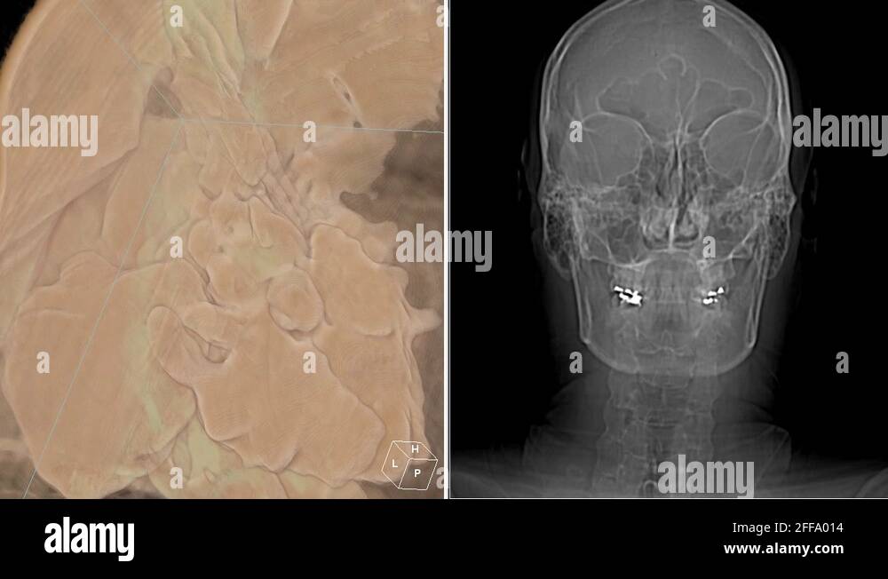 ct scan sinuses preparation