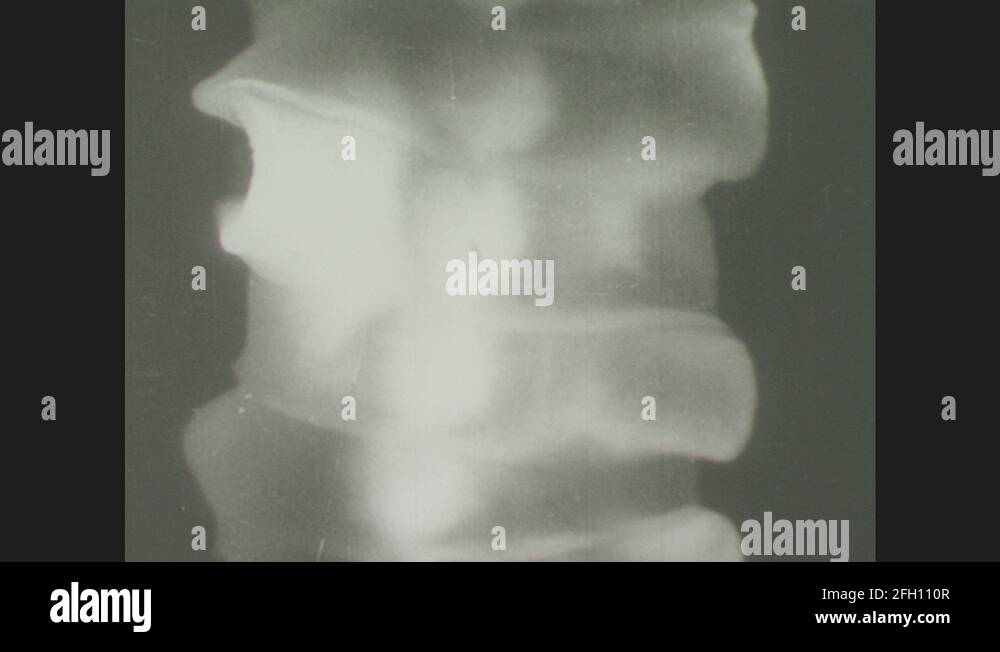 Tapeworm proglottids Stock Videos & Footage HD and 4K Video Clips Alamy