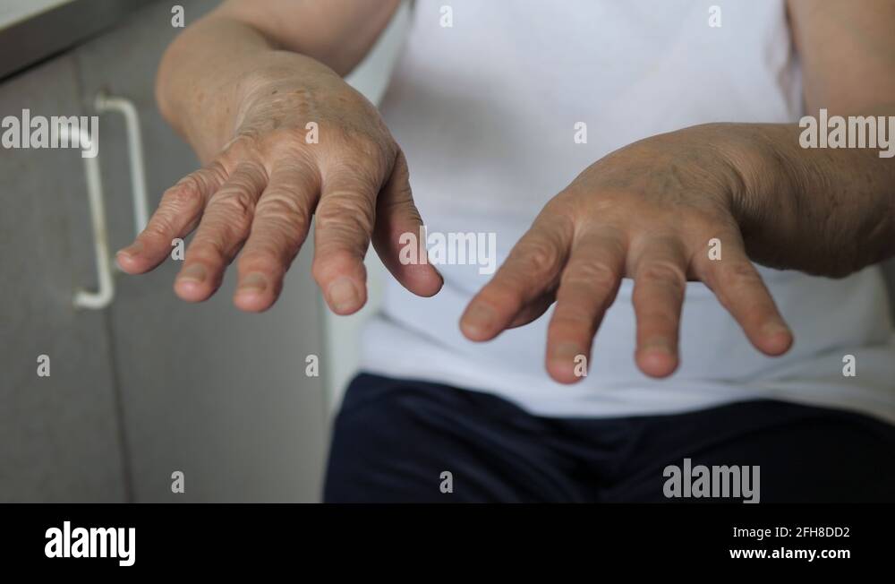 Loss Of Skin Pigment Stock Videos And Footage Hd And 4k Video Clips Alamy