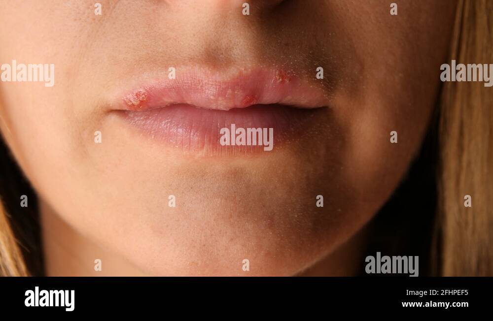 Woman touches the sores from herpes on her lips. Women's lip ulcers