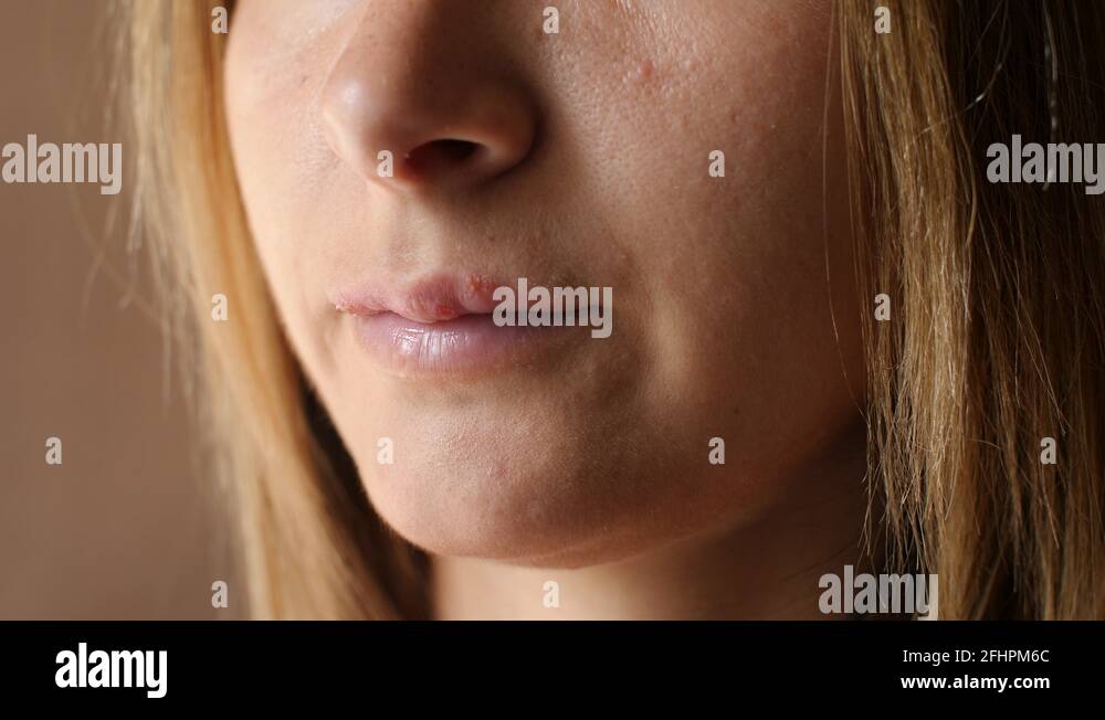 Woman touches the sores from herpes on her lips. Women's lip ulcers