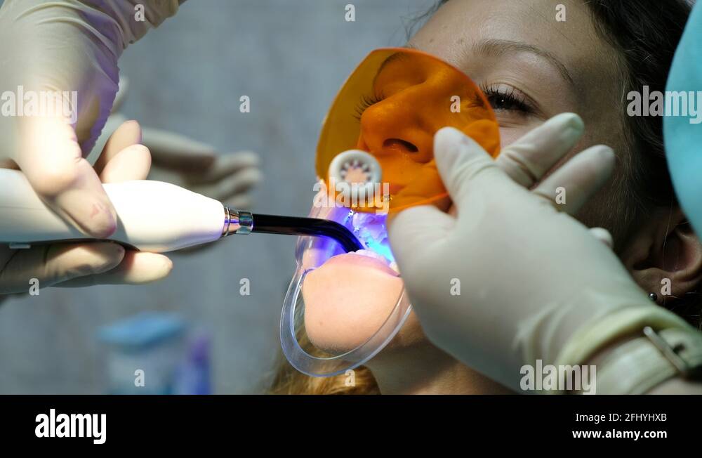 Assistant shines with a dental polymerization ultraviolet lamp to fixation the Stock Video
