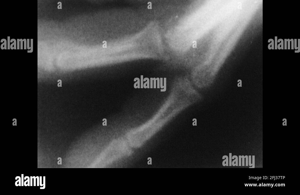 1960s Xray movement of fingers and joints in hand. Woman's hip, leg