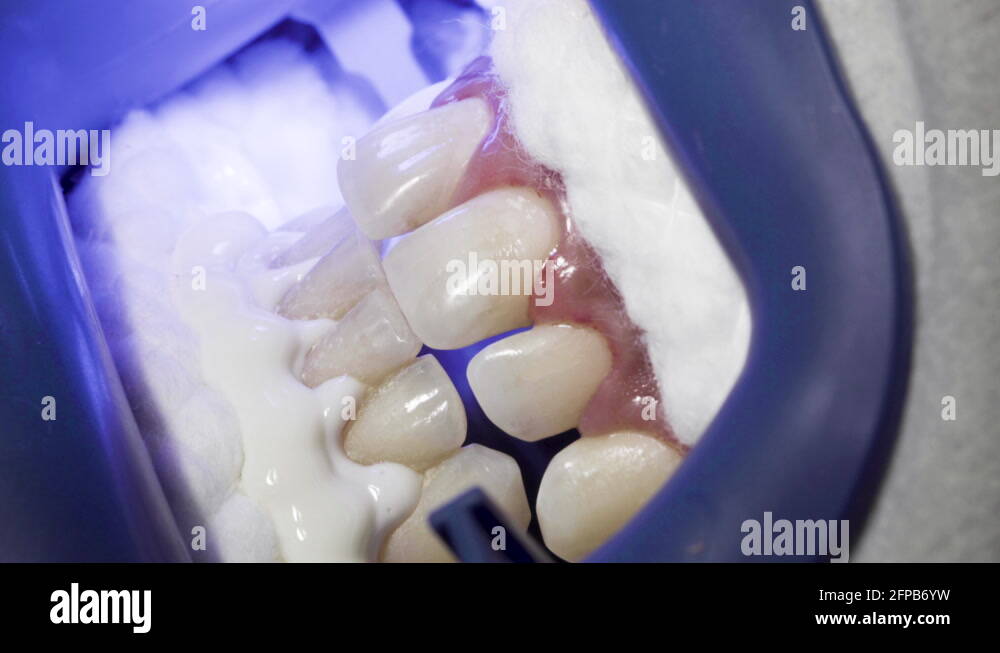 Denture plaster Stock Videos & Footage HD and 4K Video Clips Alamy