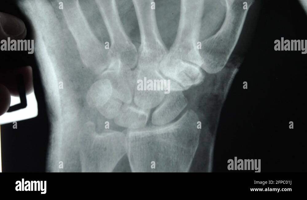 Arthritis hands xray Stock Videos & Footage HD and 4K Video Clips Alamy