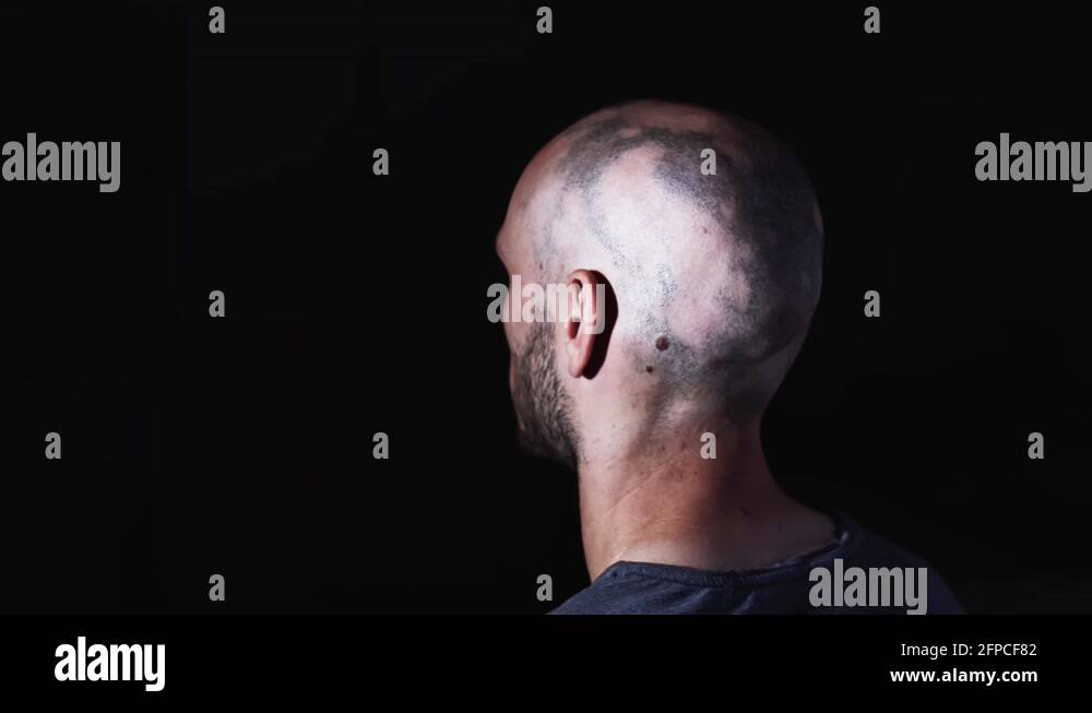 Bald cancer patient Stock Videos & Footage - HD and 4K Video Clips - Alamy