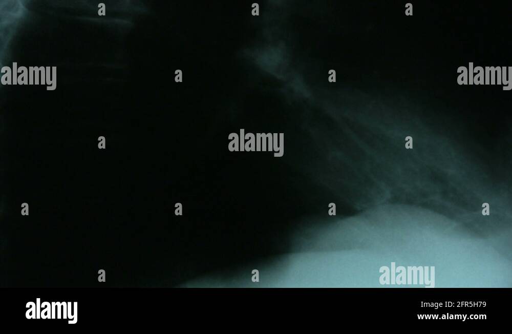 Lumbar spine x ray Stock Videos & Footage - HD and 4K Video Clips - Alamy