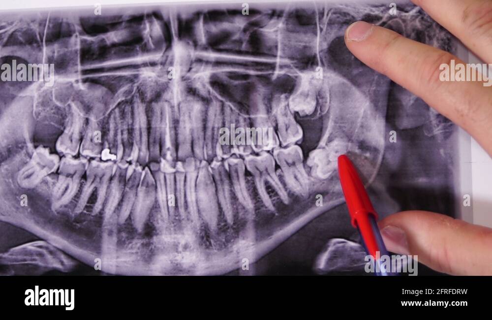 Wisdom teeth x ray Stock Videos & Footage - HD and 4K Video Clips - Alamy