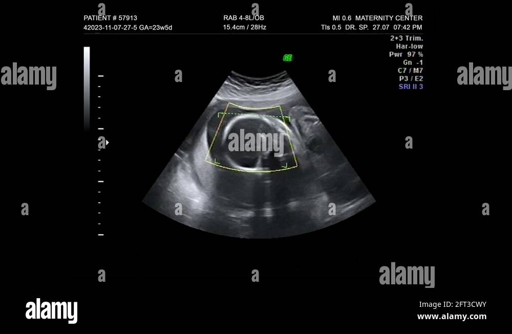 Fetus ultrasound 3d Stock Videos & Footage - HD and 4K Video Clips - Alamy