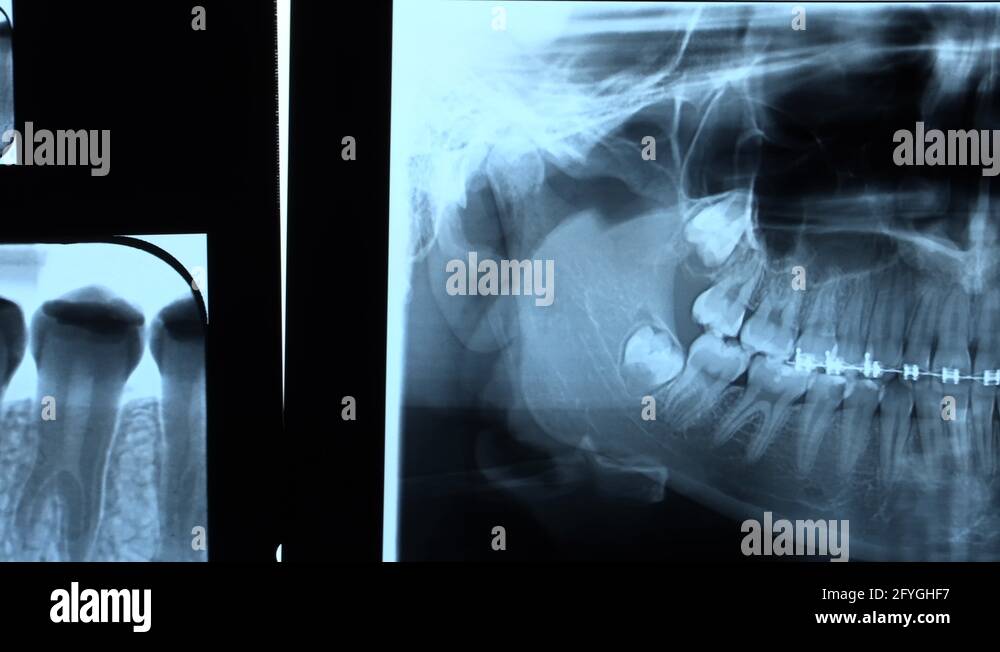 Periodontal disease with braces Stock Videos & Footage HD and 4K