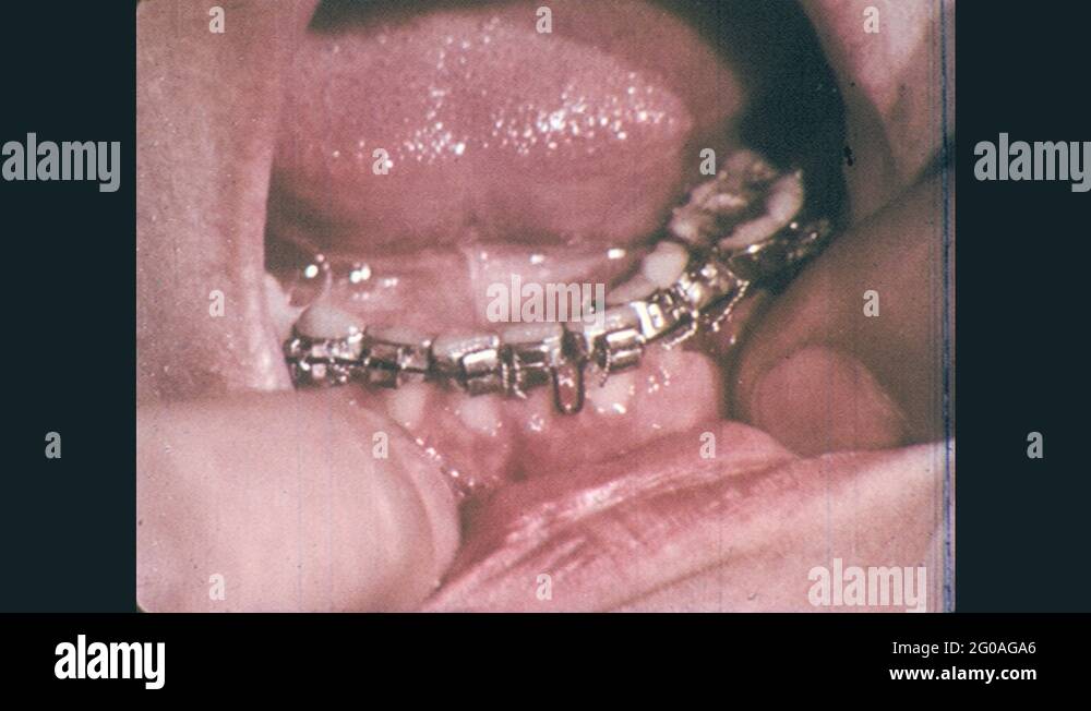 1960s Hand pulls down lip, open mouth with teeth wearing braces. Boy