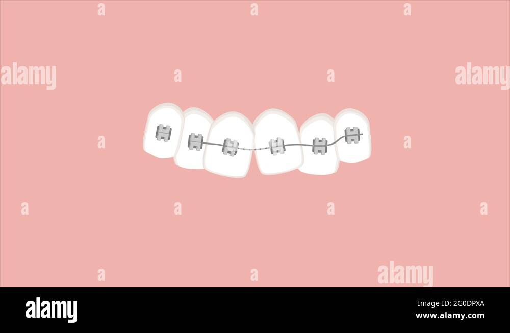 Orthodontic brace Stock Videos & Footage HD and 4K Video Clips Alamy