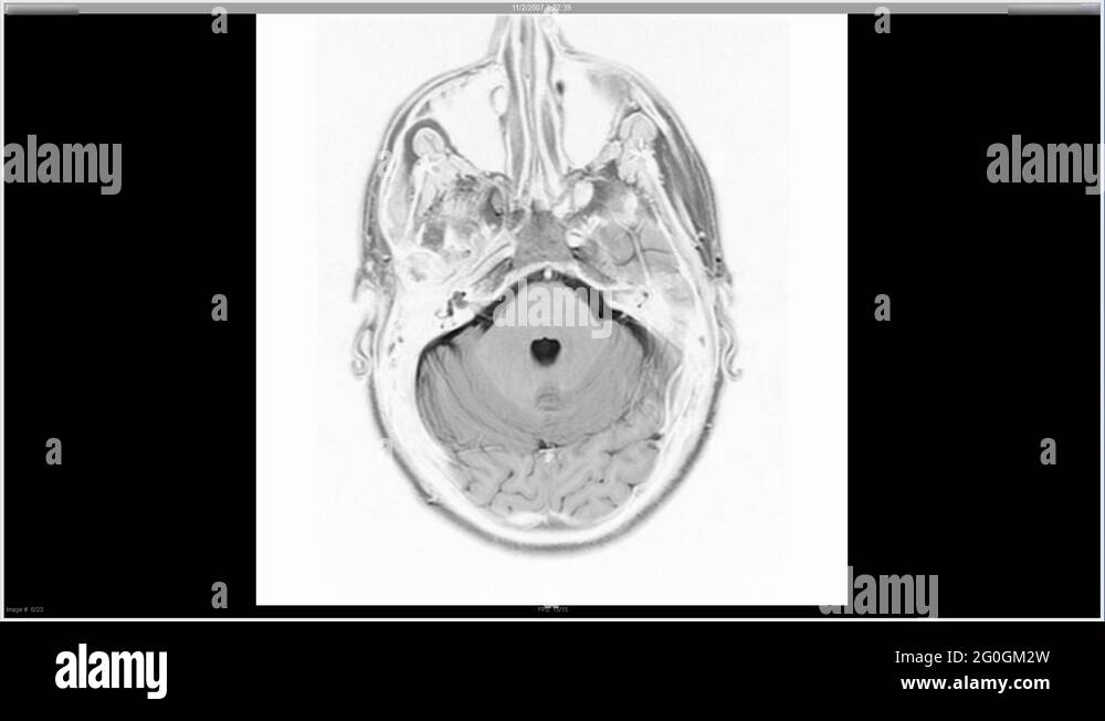 Alzheimer’s disease x ray Stock Videos & Footage HD and 4K Video