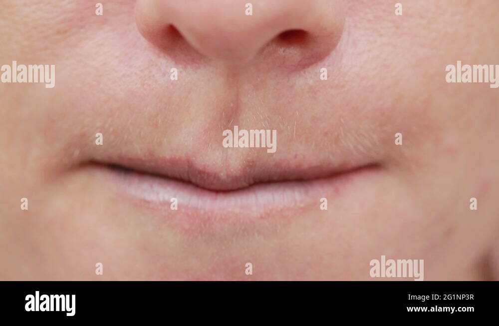 female lips with bruise. closeup. effects of hyaluronic acid. lip