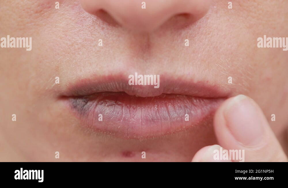 female lips with bruise. closeup. effects of hyaluronic acid. lip