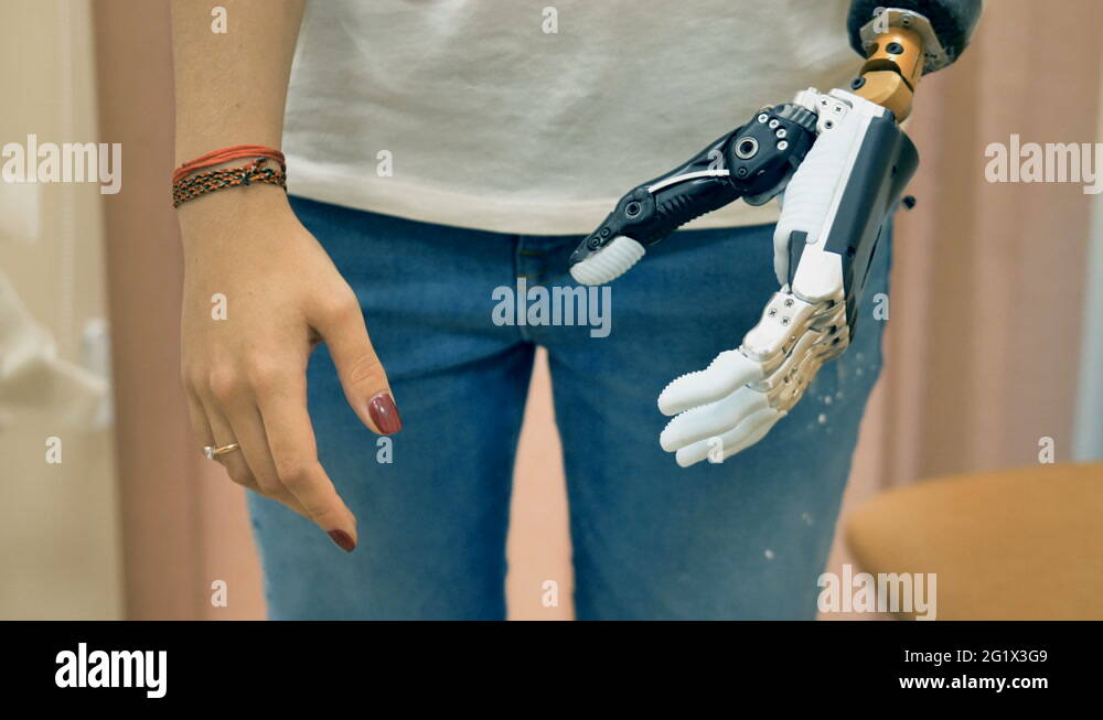 Robotic prosthesis arm connected to a disabled woman hand. 4K Stock ...