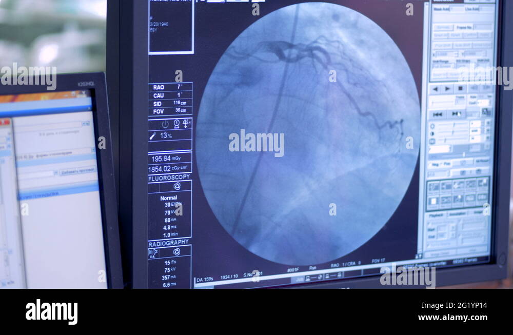 Heart x ray human Stock Videos & Footage HD and 4K Video Clips Alamy