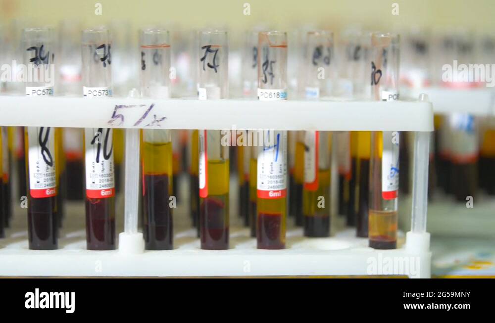 Blood clot test Stock Videos & Footage - HD and 4K Video Clips - Alamy
