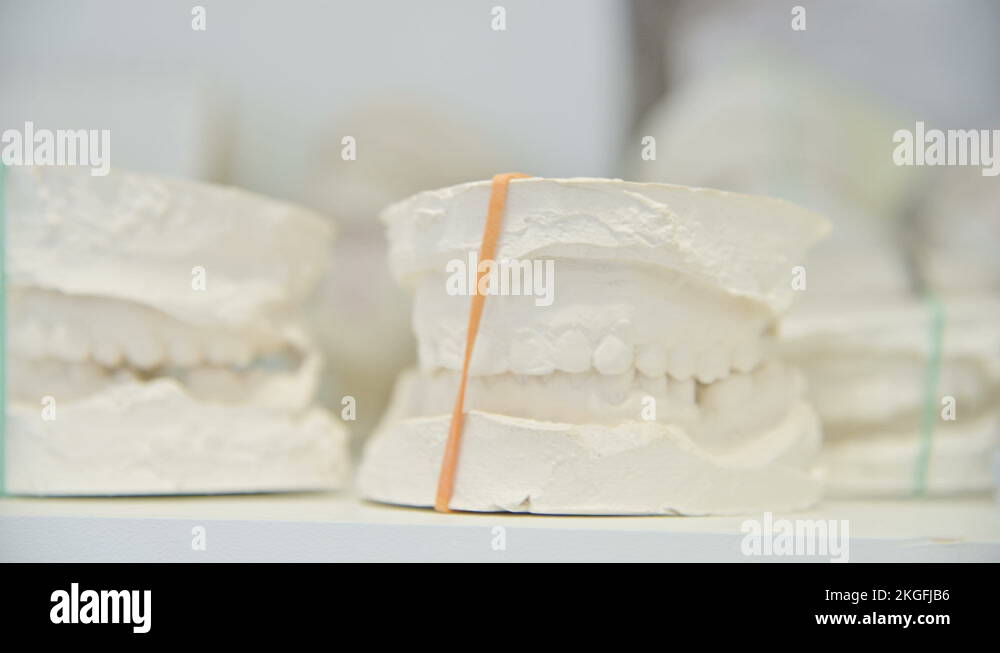 Dental gypsum model cast of human dental jaw. Laboratory prosthetics