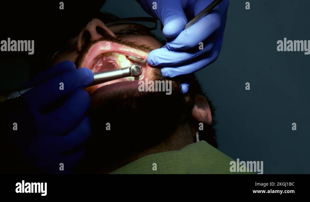 Dentist is drilling patient tooth to fill a tooth Stock Video Footage