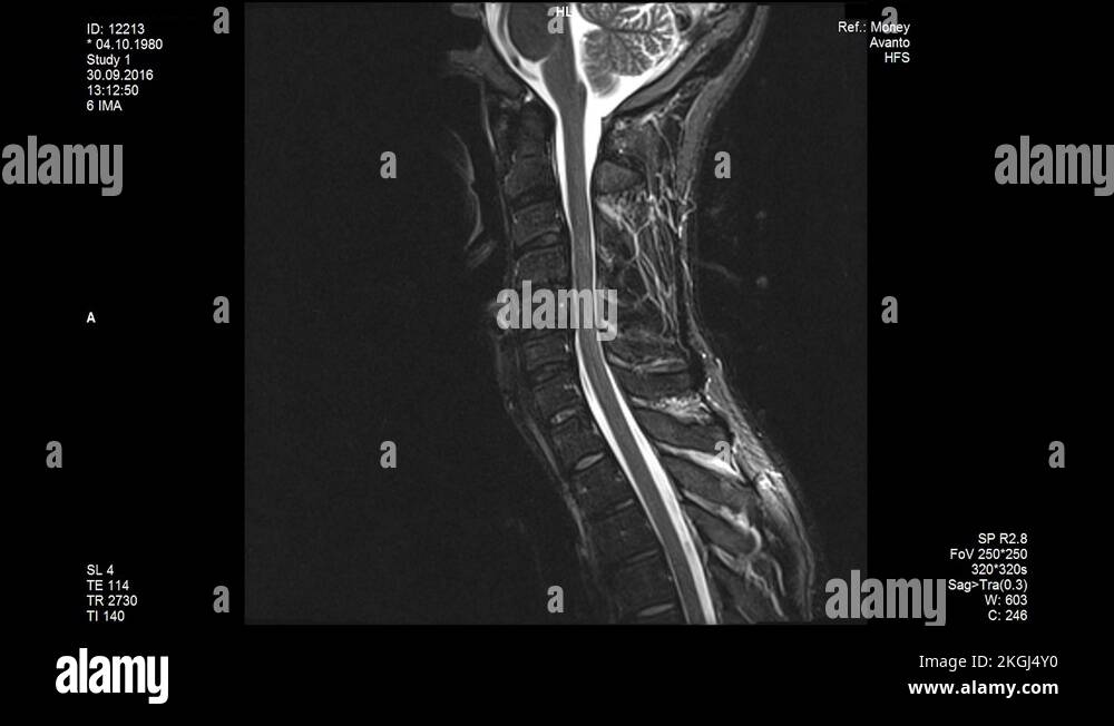 MRI scans, the lumbar spine Stock Video Footage - Alamy