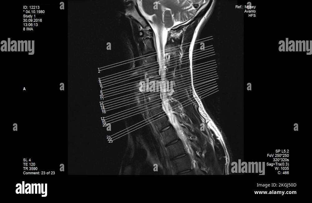 MRI scans, lumbar spine, showing the sizes Stock Video Footage - Alamy