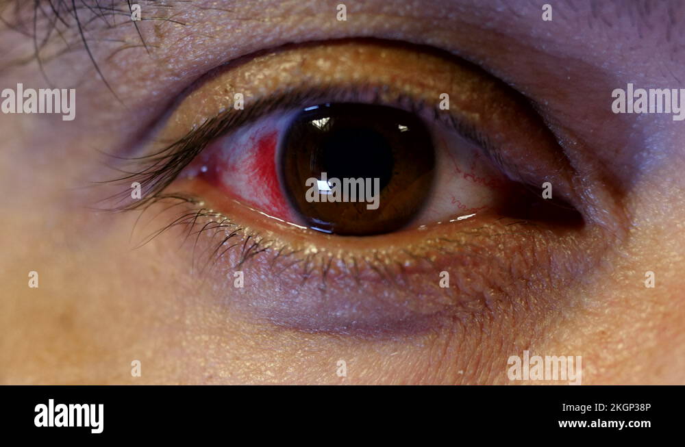 Broken blood vessels Stock Videos & Footage HD and 4K Video Clips Alamy