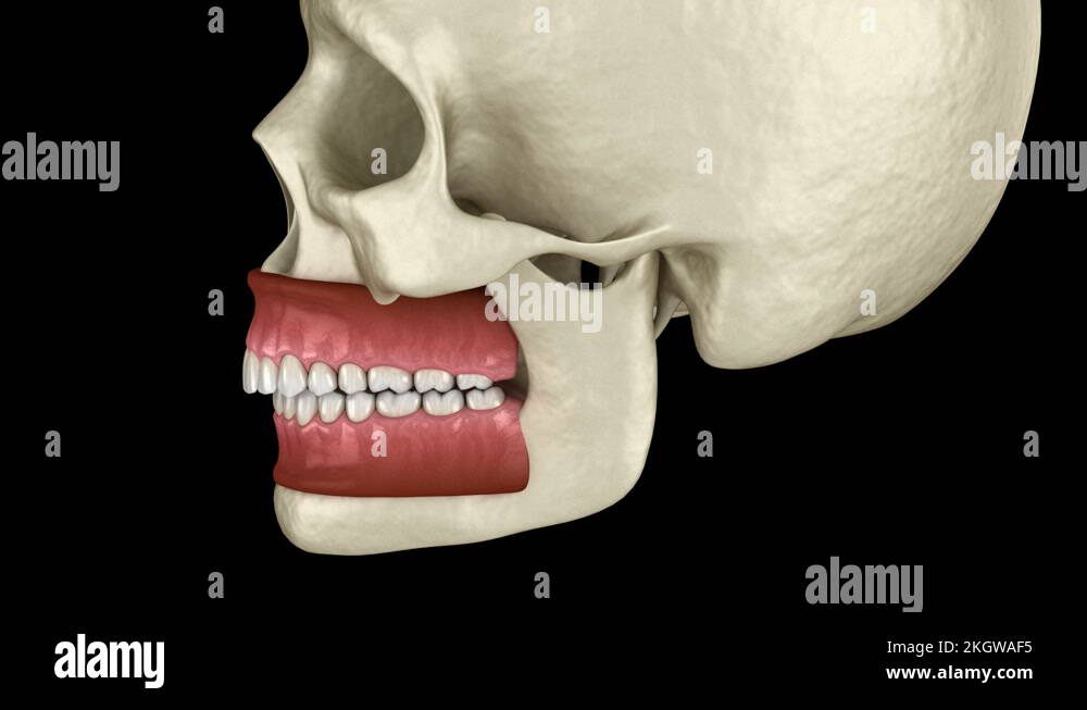 Dental overbite Stock Videos & Footage - HD and 4K Video Clips - Alamy