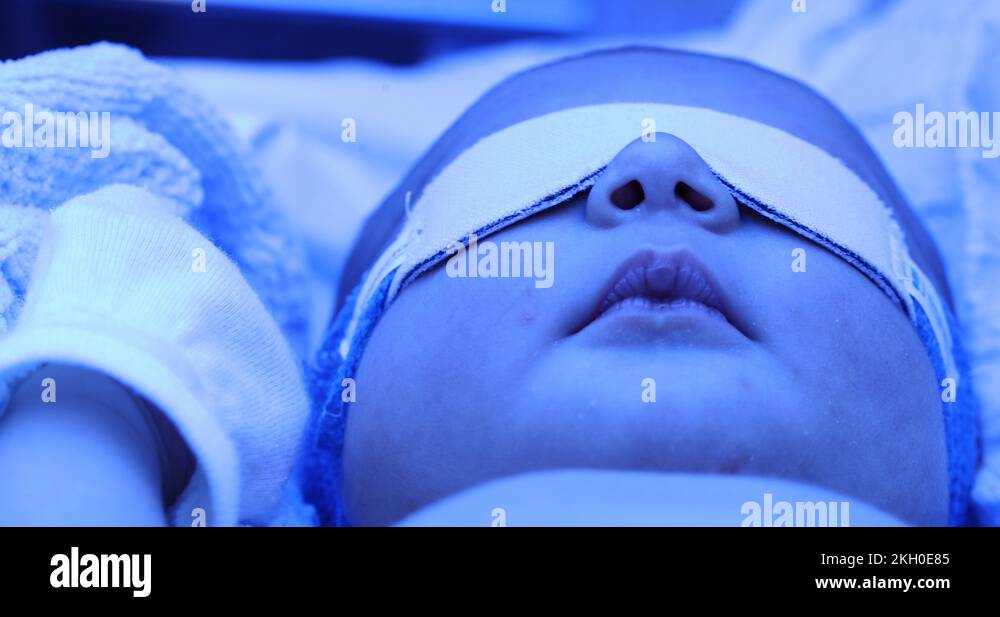 Newborn baby boy under phototherapy lamp. getting treated for jaundice