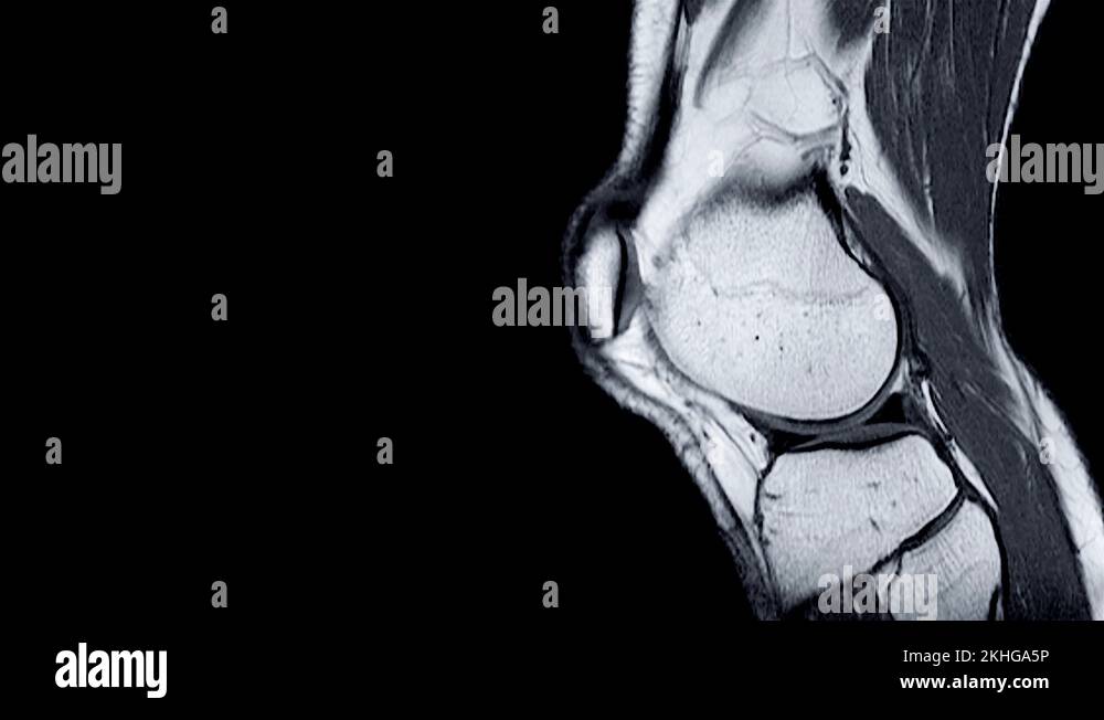 resonance imaging (MRI) of right knee. Closed injury of the