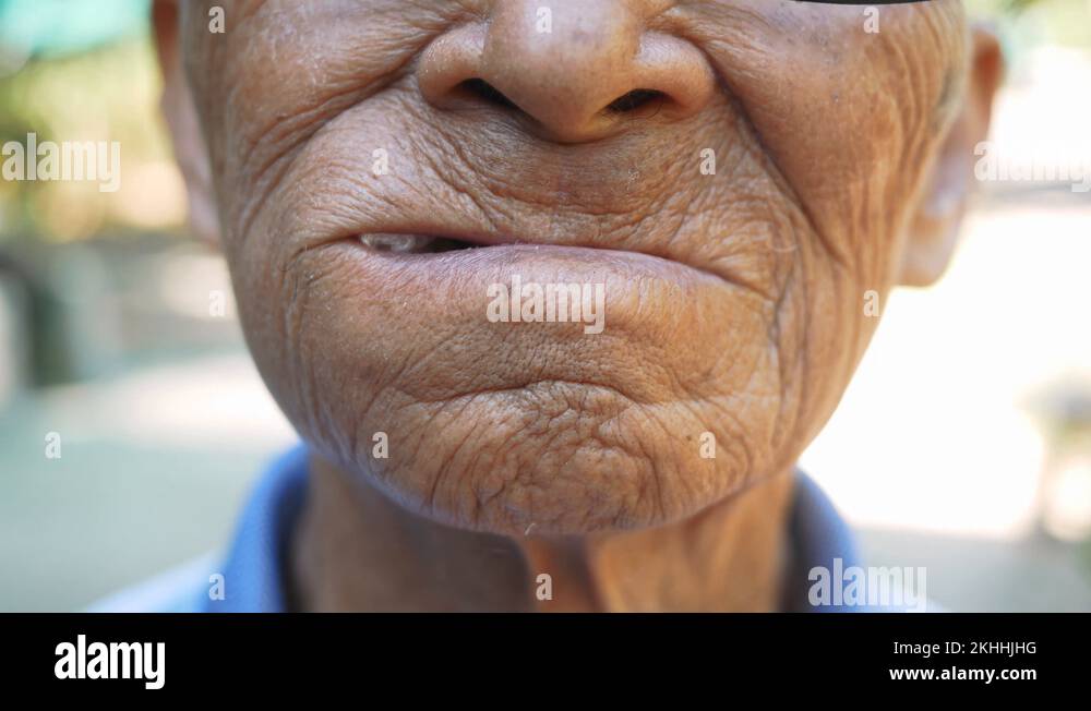 Elderly man biting on cotton gauze after tooth extraction, Tooth decay