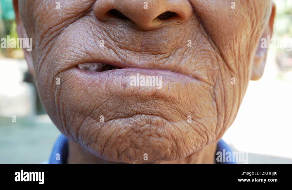 Elderly man biting on cotton gauze after tooth extraction, Tooth decay