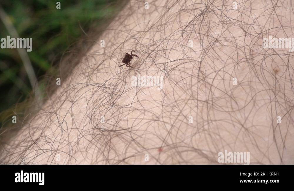 Tick On The Human Skin Slow Motion 240 Fps Tick Borne Disease Vector Stock Video Footage Alamy 3676