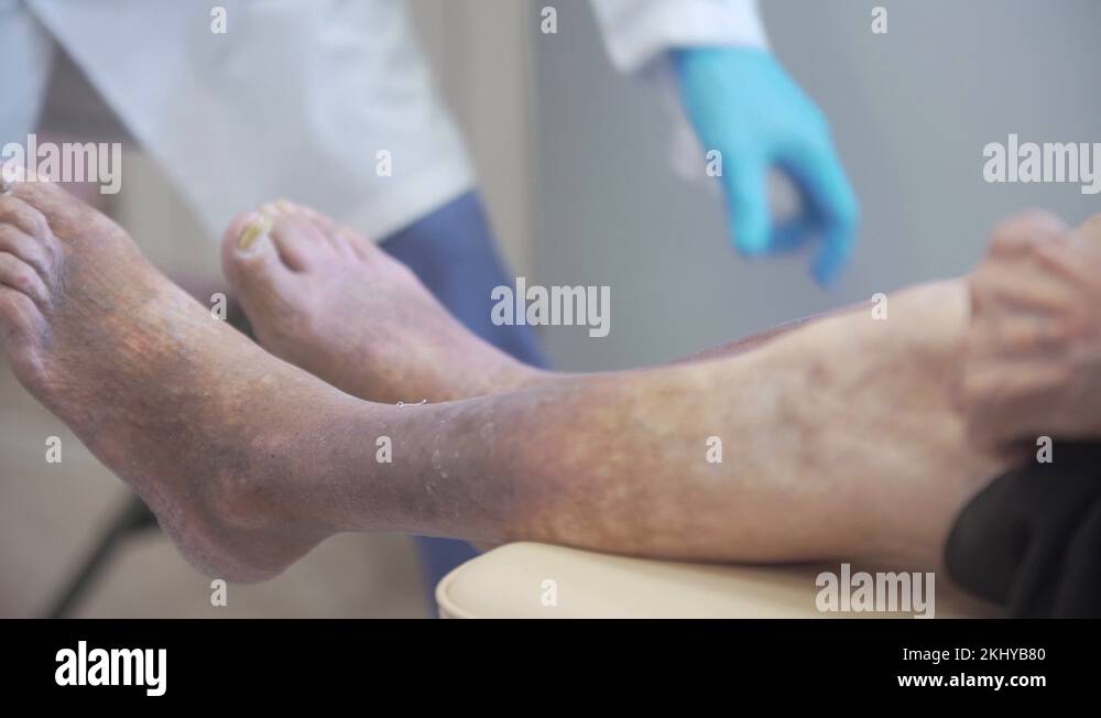 Sore Feet, blood Clot, Thrombophlebitis, trophic ulcers, leg ligation