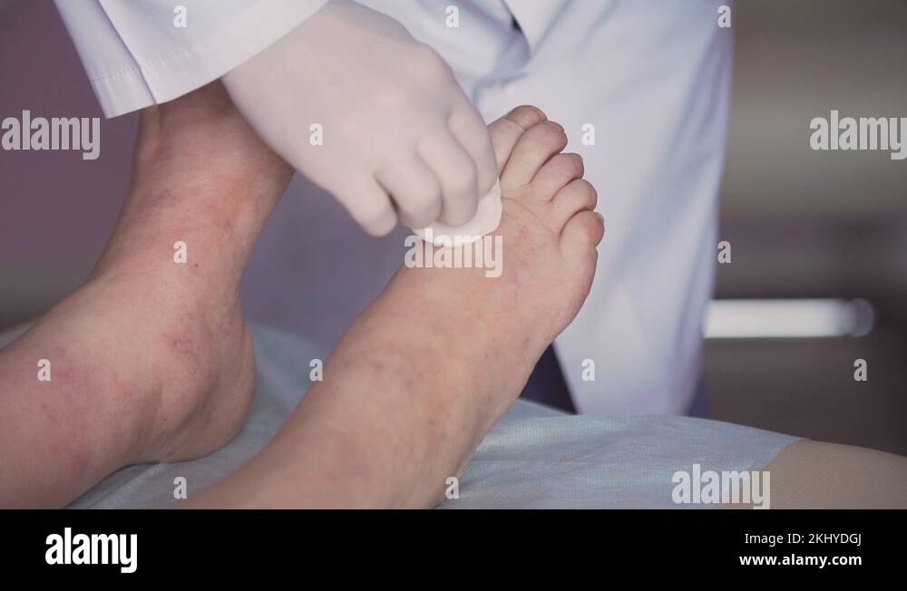 sore feet, swollen feet, leg edema, varicose veins , injections Stock