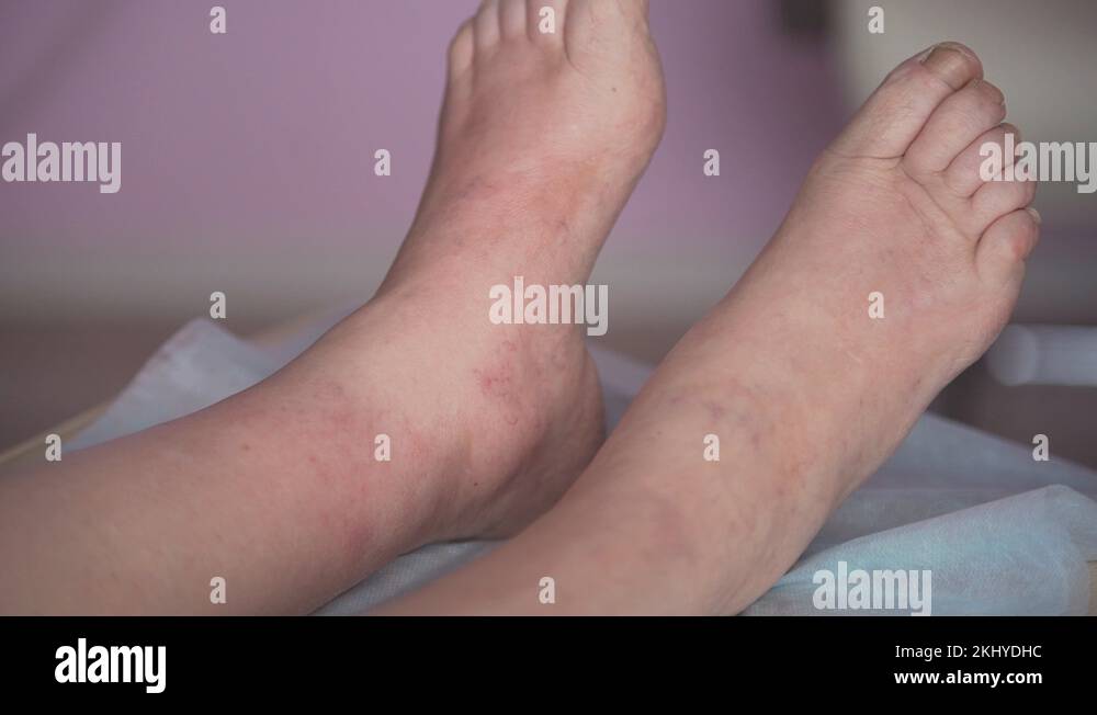 sore feet, swollen feet, leg edema, varicose veins , varicose veins