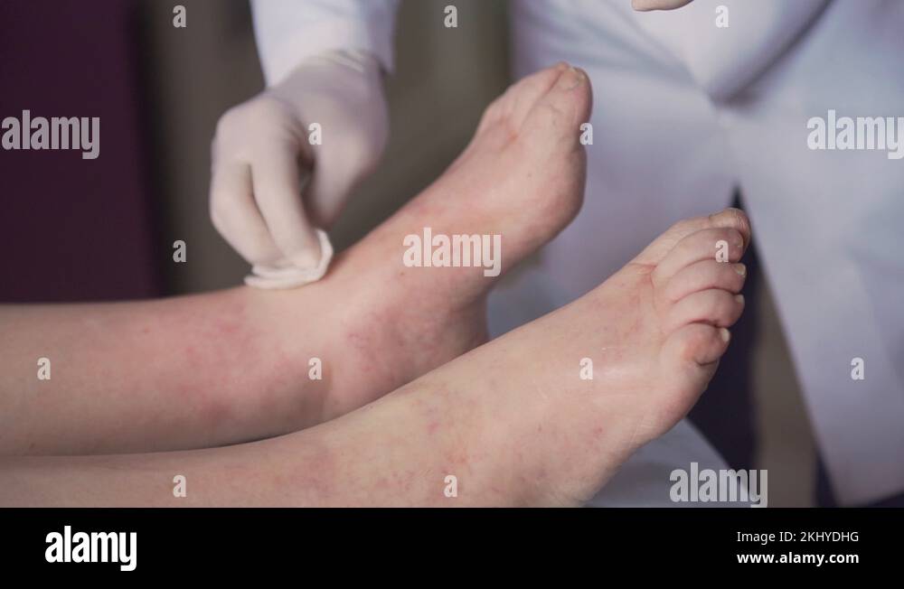 sore feet, swollen feet, leg edema, varicose veins , injections Stock