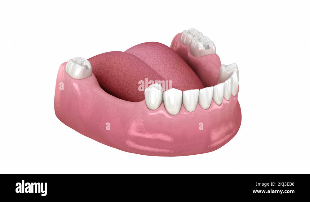 Removable partial denture, mandibular prosthesis Stock Video Footage