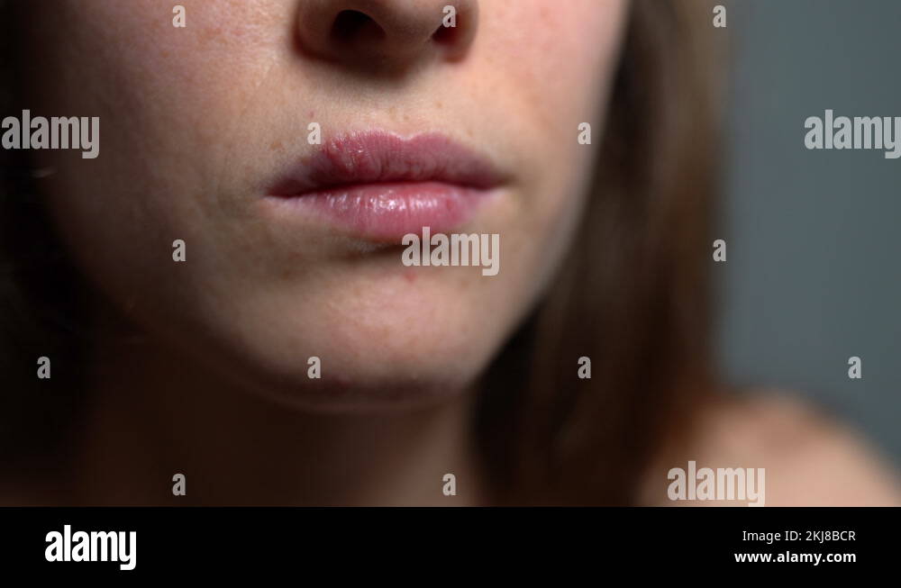 Herpes sores Stock Videos & Footage - HD and 4K Video Clips - Alamy